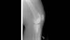 Ortho Dx: Knee pain and joint effusion years after TKA Ortho Dx: Knee pain and joint effusion years after TKA