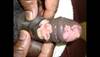 Derm Dx: Penile lesions in an HIV-positive man Derm Dx: Penile lesions in an HIV-positive man