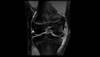 Ortho Dx: MCL tear in a teen lacrosse player Ortho Dx: MCL tear in a teen lacrosse player