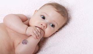 Topical timolol maleate may be safe and effective for infantile hemangiomas. Topical timolol maleate may be safe and effective for infantile hemangiomas.