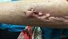 Ortho Dx: Painful calcium deposits on the forearm Ortho Dx: Painful calcium deposits on the forearm