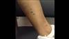 Derm Dx: Deeply hyperpigmented, slightly raised papules Derm Dx: Deeply hyperpigmented, slightly raised papules