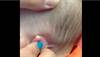 Derm Dx: A waxy, yellowish plaque since birth Derm Dx: A waxy, yellowish plaque since birth