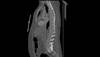 Ortho Dx: Incapacitating back pain after a car accident Ortho Dx: Incapacitating back pain after a car accident