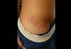 Diagnosing Pediatric Lyme Arthritis Diagnosing Pediatric Lyme Arthritis