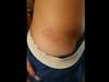 Derm Dx: Is this Lyme disease? Derm Dx: Is this Lyme disease?