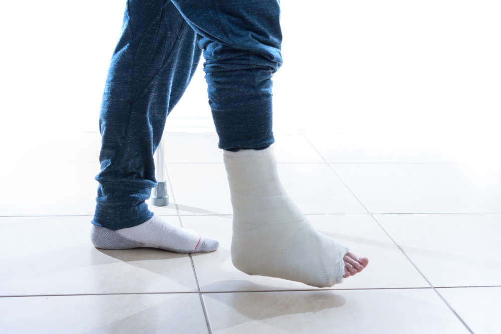 New Plaster Cast May Help Seniors Avoid Surgery For Ankle Fractures