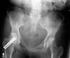 Ortho Dx: Pelvic bone fracture after a fall Ortho Dx: Pelvic bone fracture after a fall