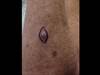Derm Dx: A new growth on a woman who has had skin cancer Derm Dx: A new growth on a woman who has had skin cancer
