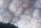 Celiac disease Celiac disease