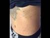 Derm Dx: Dermatitis over the torso that looks like an allergic reaction Derm Dx: Dermatitis over the torso that looks like an allergic reaction
