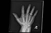 Ortho Dx: Thumb pain with repeated lifting Ortho Dx: Thumb pain with repeated lifting