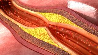 Researchers conducted a prespecified subgroup analysis of a randomized clinical trial of endovascular treatment at 16 hospitals in the Netherlands. Researchers conducted a prespecified subgroup analysis of a randomized clinical trial of endovascular treatment at 16 hospitals in the Netherlands.