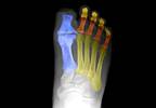 Diabetic peripheral neuropathy: an overview Diabetic peripheral neuropathy: an overview