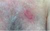 Derm Dx: A farmer's rash that worsened with topical corticosteroid Derm Dx: A farmer's rash that worsened with topical corticosteroid