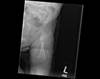 Ortho Dx: Femur fracture before walking age Ortho Dx: Femur fracture before walking age