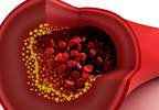 Statin and PCSK9 inhibitor combination more effective at lowering cholesterol Statin and PCSK9 inhibitor combination more effective at lowering cholesterol
