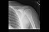 Ortho Dx: A rare source of shoulder pain Ortho Dx: A rare source of shoulder pain