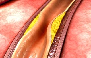 The AHA/ACC guideline updates the 2005 recommendations on PAD management. The AHA/ACC guideline updates the 2005 recommendations on PAD management.