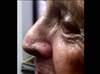Derm Dx: A rare neoplasm on the nose Derm Dx: A rare neoplasm on the nose