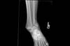 Ortho Dx: How would you treat this ankle fracture dislocation? Ortho Dx: How would you treat this ankle fracture dislocation?
