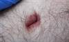 Derm Dx: A rash about the umbilicus Derm Dx: A rash about the umbilicus