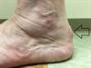 Ortho Dx: A bump on the back of the heel Ortho Dx: A bump on the back of the heel