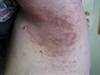 Derm Dx: A rash on the axillae that sometimes itches or burns Derm Dx: A rash on the axillae that sometimes itches or burns