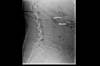 Ortho Dx: What are the grade and type of this spondylolisthesis? Ortho Dx: What are the grade and type of this spondylolisthesis?