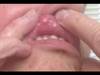 Derm Dx: A painful lesion on the inside of the lip Derm Dx: A painful lesion on the inside of the lip