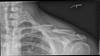 Ortho Dx: How would you treat this clavicle fracture? Ortho Dx: How would you treat this clavicle fracture?