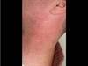 Derm Dx: A growing rash on a man with a history of sun exposure Derm Dx: A growing rash on a man with a history of sun exposure