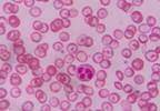 Crizanlizumab reduces sickle cell-related pain Crizanlizumab reduces sickle cell-related pain