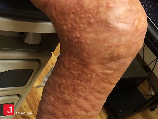 Image of the Week: Cutaneous cobblestone lesions