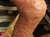 Image of the Week: Cutaneous cobblestone lesions Image of the Week: Cutaneous cobblestone lesions