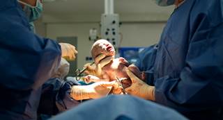 Delayed umbilical cord clamping is associated with significant neonatal benefits, including improved transitional circulation and better establishment of red blood cell volume. Delayed umbilical cord clamping is associated with significant neonatal benefits, including improved transitional circulation and better establishment of red blood cell volume.