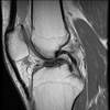 Ortho Dx: A double posterior cruciate ligament sign Ortho Dx: A double posterior cruciate ligament sign