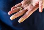 Raynaud phenomenon: a cold-weather condition Raynaud phenomenon: a cold-weather condition