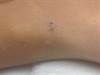 Derm Dx: Scattered papules on a high school football player Derm Dx: Scattered papules on a high school football player