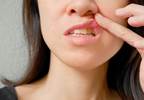 Food additives may affect recurrent aphthous stomatitis Food additives may affect recurrent aphthous stomatitis