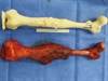 Image of the Week: How 3D printing is being used to treat cancer Image of the Week: How 3D printing is being used to treat cancer