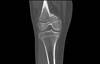 Ortho Dx: Growth disturbances following growth plate fracture Ortho Dx: Growth disturbances following growth plate fracture