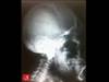 Image of the Week: When a tight wedding ring suggests a rare diagnosis Image of the Week: When a tight wedding ring suggests a rare diagnosis