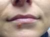 Derm Dx: Vesiculation under the lip Derm Dx: Vesiculation under the lip