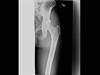 Ortho Dx: Snapping hip Ortho Dx: Snapping hip
