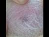 Derm Dx: A hairdresser notices a scalp lesion on her client Derm Dx: A hairdresser notices a scalp lesion on her client