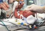 Antenatal steroids may improve respiratory outcomes for late preterm births Antenatal steroids may improve respiratory outcomes for late preterm births