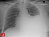 Image of the Week: Which drug might prevent this condition? Image of the Week: Which drug might prevent this condition?