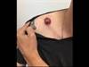 Derm Dx: A pimple that didn't stop growing Derm Dx: A pimple that didn't stop growing