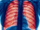 Clinical Characteristics of Eosinophilic COPD vs COPD With Asthma Clinical Characteristics of Eosinophilic COPD vs COPD With Asthma